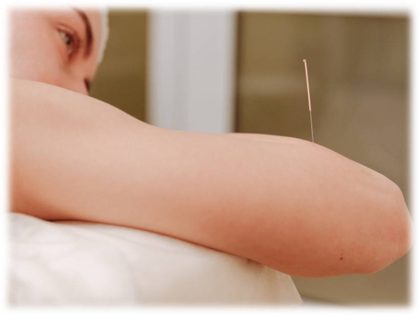 Acupuncture for stress relief, pain management and overall wellness